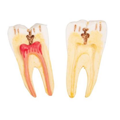 Choroby zębów_7