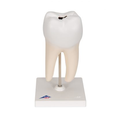 Dolny ząb trzonowy z próchnicą_1