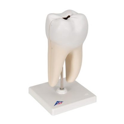 Dolny ząb trzonowy z próchnicą_3