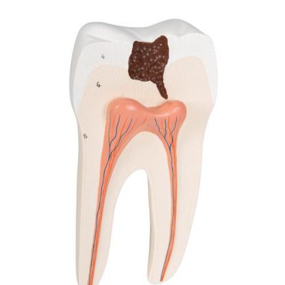 Dolny ząb trzonowy z próchnicą_7
