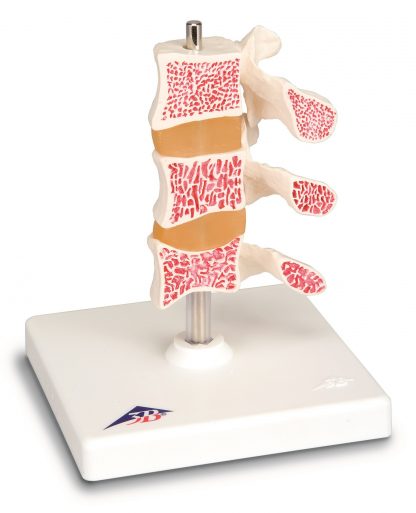 Model osteoporozy