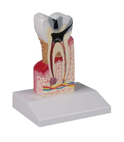 Model próchnicy zęba