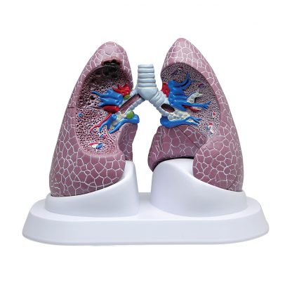 Model płuc z patologiami
