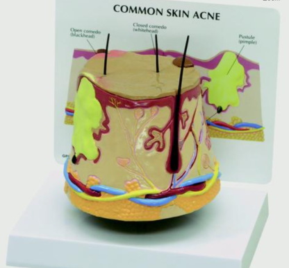 Model skóry ze zmianami trądzikowymi