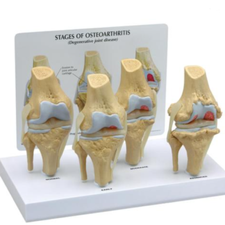 Osteoporoza kolana cztery stadia